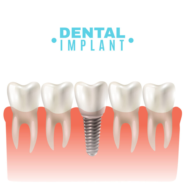 Dental Implants 101: The Ultimate Guide to Restoring Your Smile