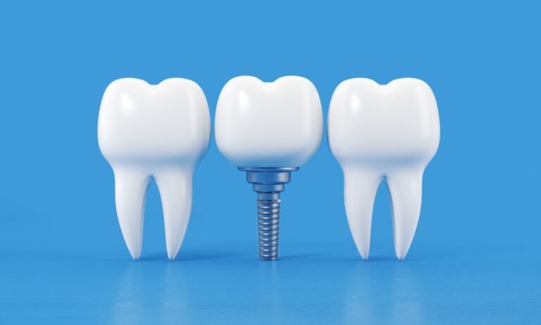 Maximize Dental Implant Success with a Medicaid-Accepting Periodontist